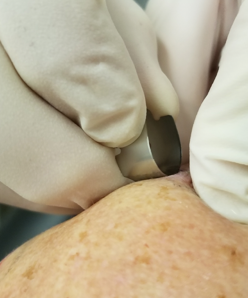 Biópsia para anatomopatológico na Presecor
